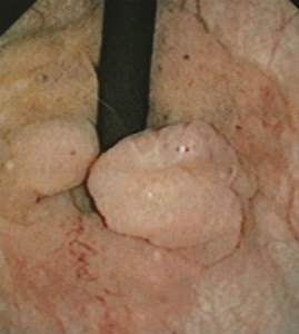 膀胱内部腫瘍