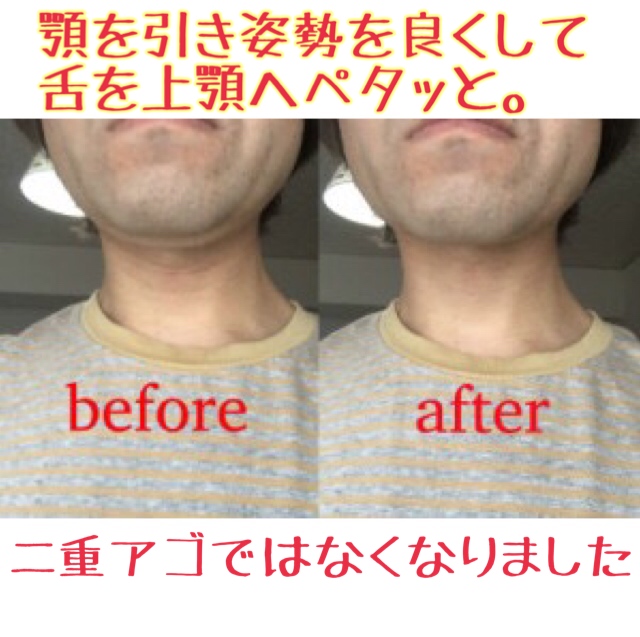 二 重 アゴ 治し 方 速攻